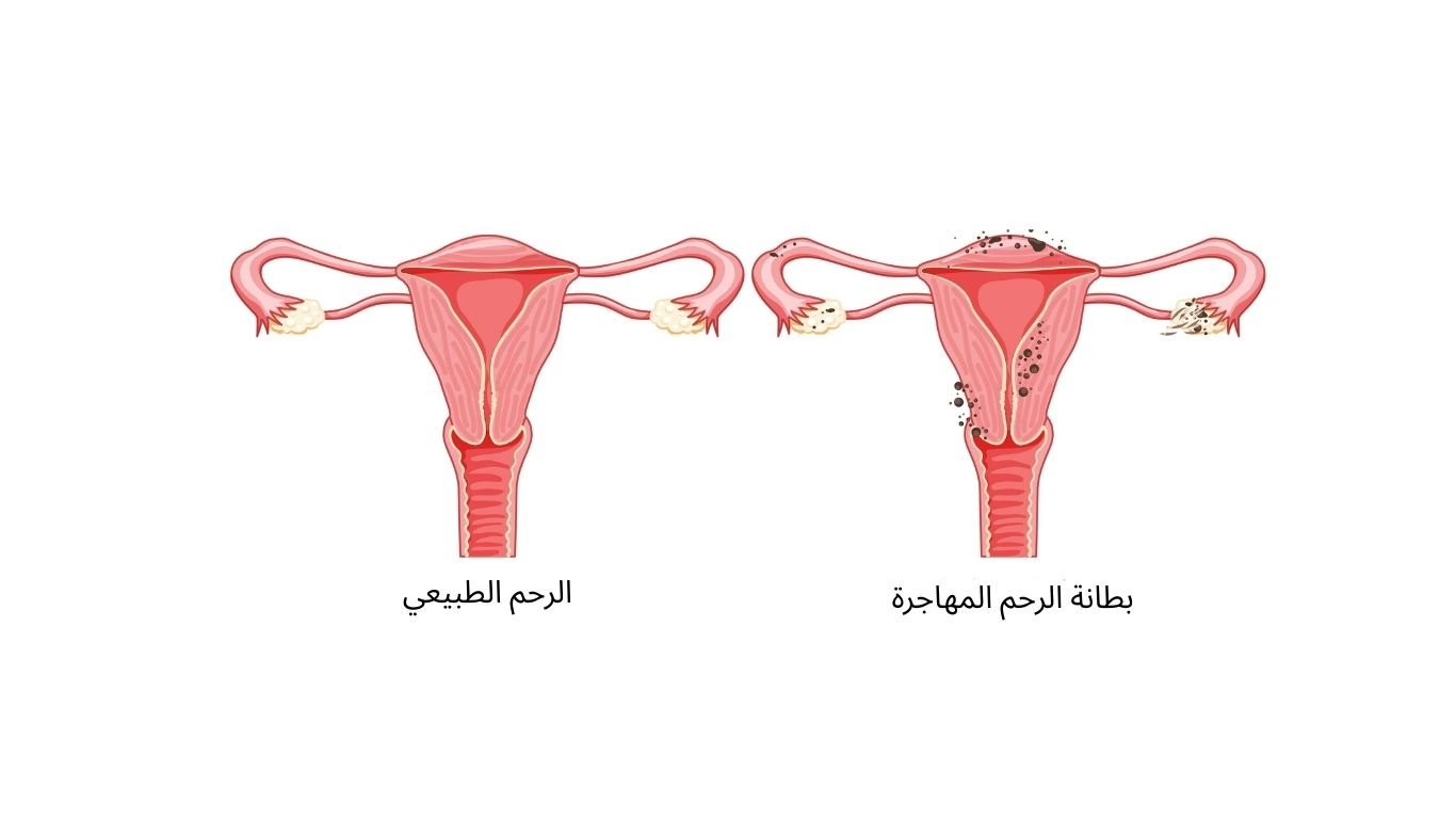 بطانة الرحم المهاجرة: الأعراض، الأسباب، والعلاج بالمنظار