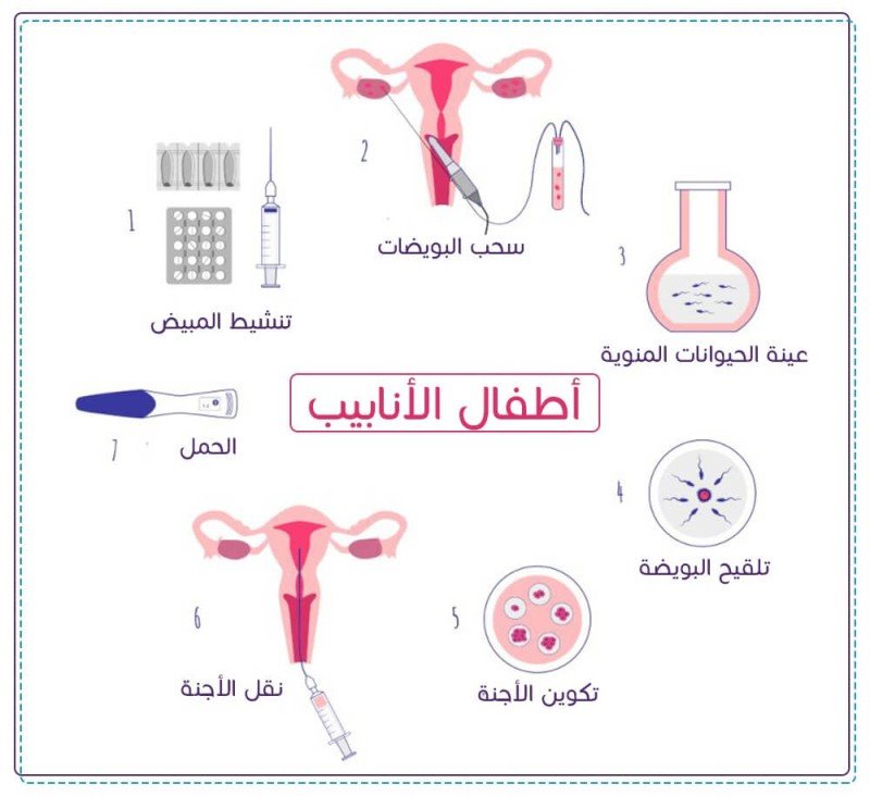 مراحل عملية أطفال الأنابيب من التحضير حتى ثبات الحمل